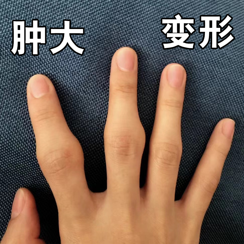 手指关节变形肿大粗大僵硬疼痛专用药贴修复美手类风湿性关节炎贴