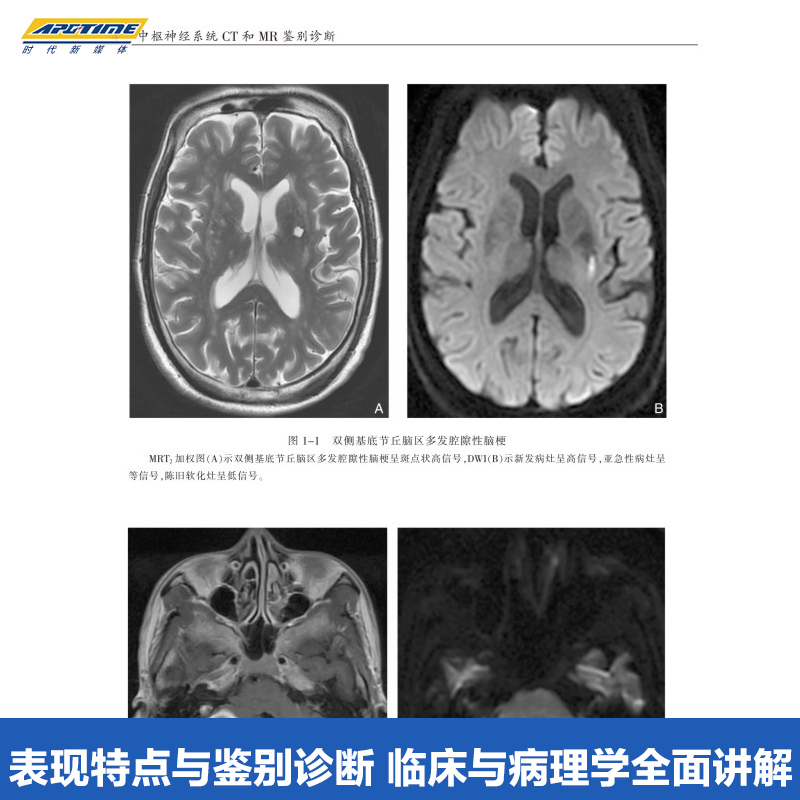 中枢神经系统CT和MR鉴别诊断 第3版 鱼博浪 对疾病的临床和病理均有较详细的描述 陕西科学技术出版社SXKJ